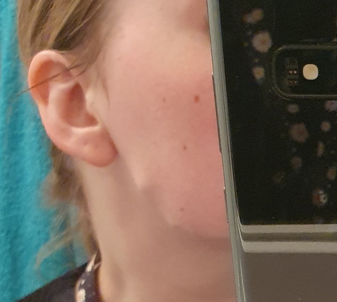 Jawline filler, are obvious lumps normal at first?