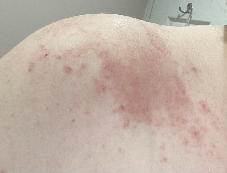 ‘Covid’ rash post vaccines (pics)