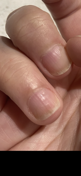 Aibu to go to GP about fingernail line?