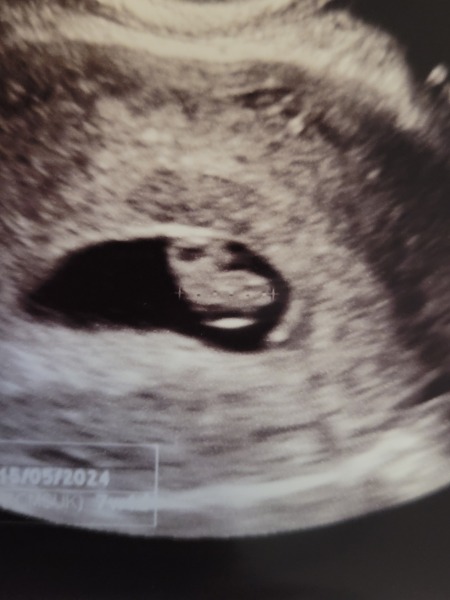 What is this on my baby scan?
