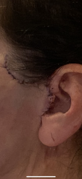 Has anyone had plastic/cosmetic surgery?