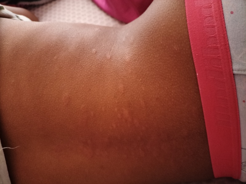 What are these bites?