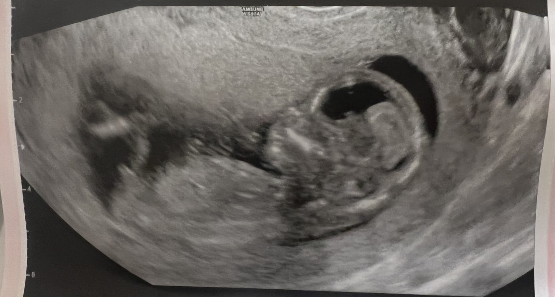 Boy or girl guesses