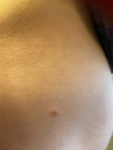 Chicken pox or bed bugs