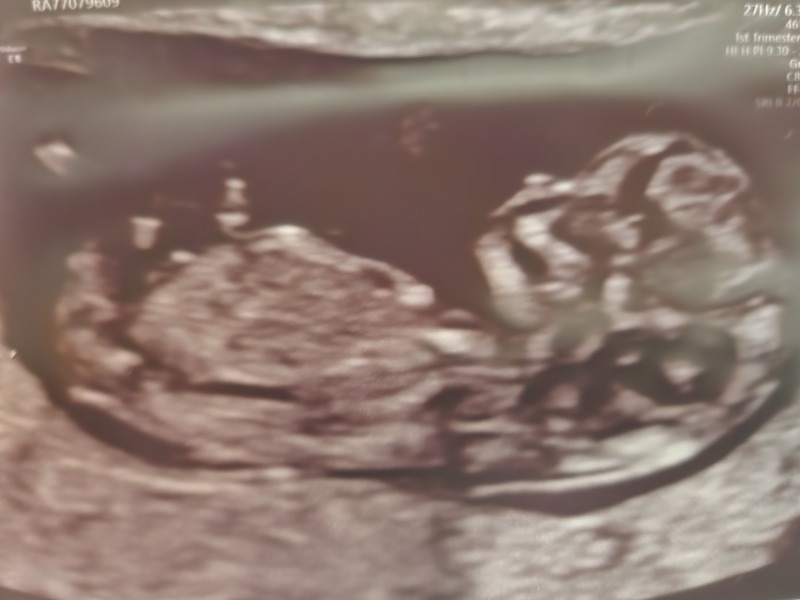 12 week scan