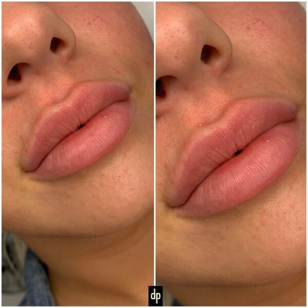 Can you tell I’ve had lip filler?