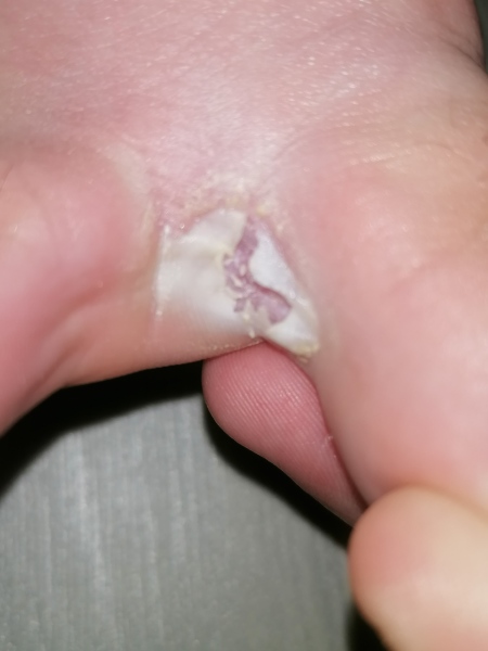 *Pic  *sore between toe. What is it