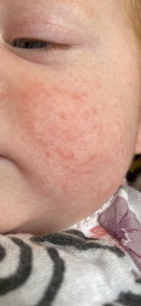 Rash on baby's face - pic