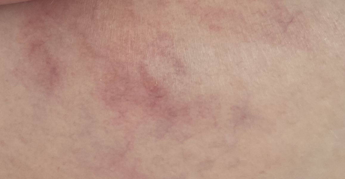 ERA/Alice/Emma infertility thread graduates/pregnancies