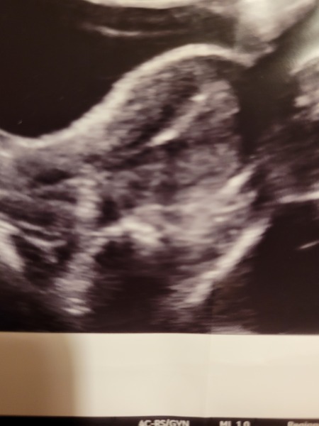 Picture of double embryo transfer.. why can I only see one