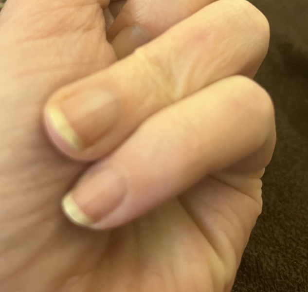 Aibu to go to GP about fingernail line?