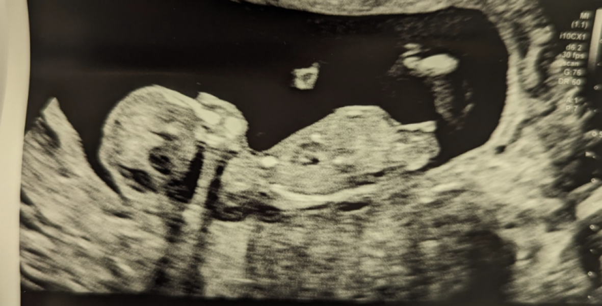 Boy or girl?