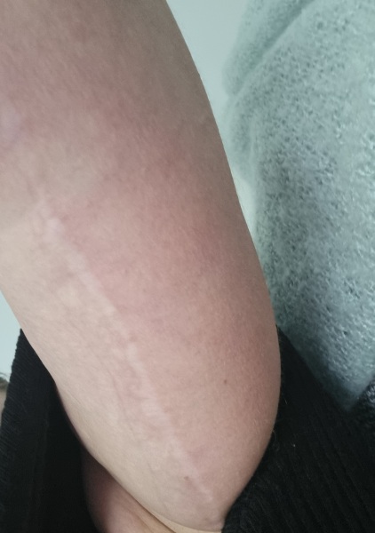 I had a body lift in Turkey AMA