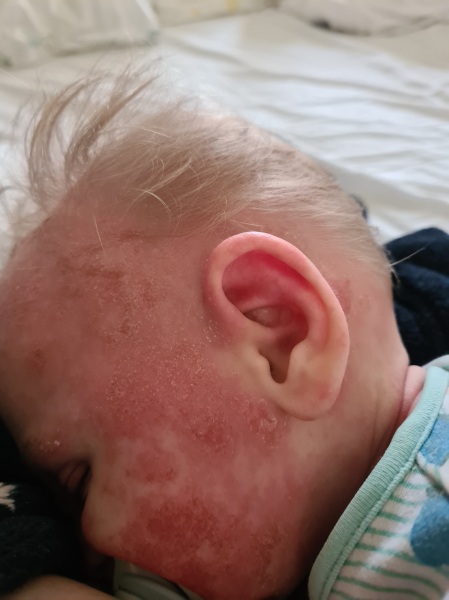 Eczema red raw babys face