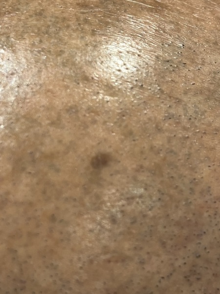mole pic attached
