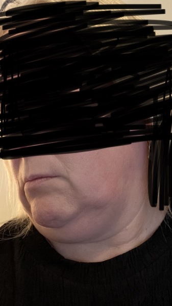 Does anyone want to come on my Upper and Lower Bleph and Necklift journey with me?