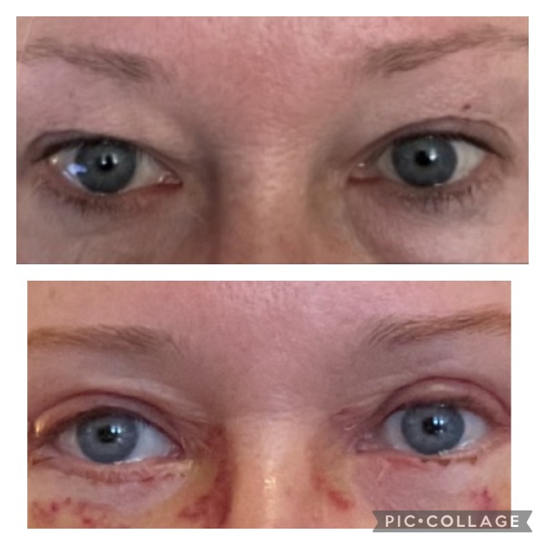 Does anyone want to come on my Upper and Lower Bleph and Necklift journey with me?