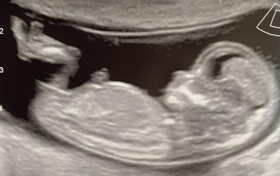 Nub theory boy or girl ? Interested to hear people’s thoughts