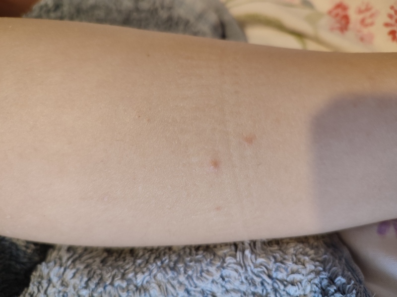 Spots on 5 year olds leg
