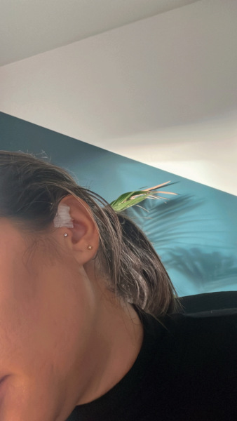 Piercing stuck beneath skin