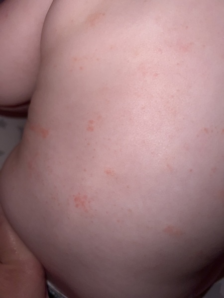 Anyone know what this rash is?