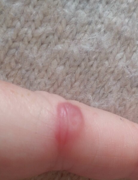 Should I pop this? Pic attached