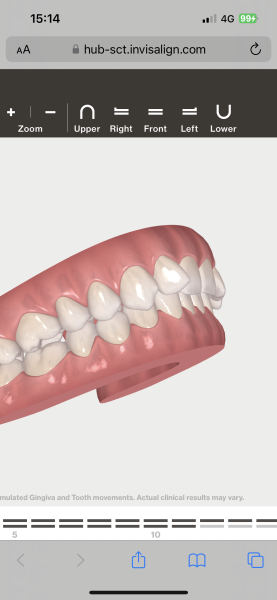 Braces/invisalign