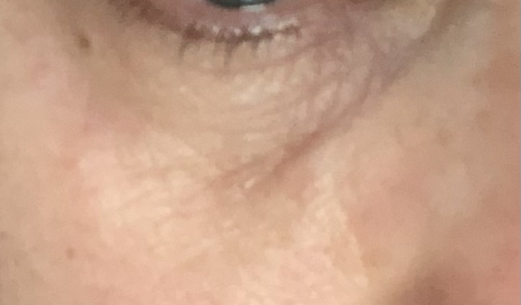 Under eye darkness