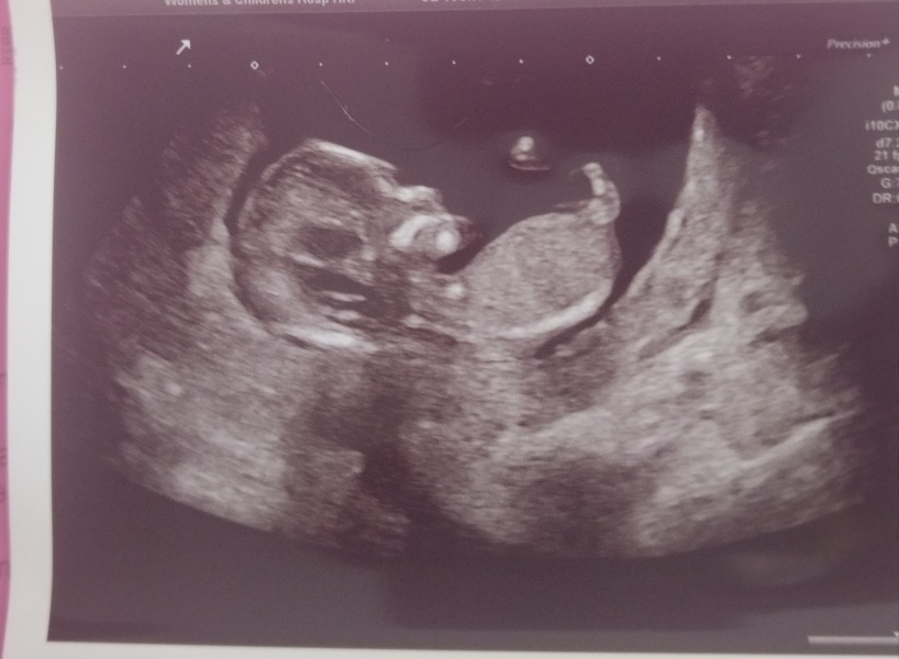 12 week scan