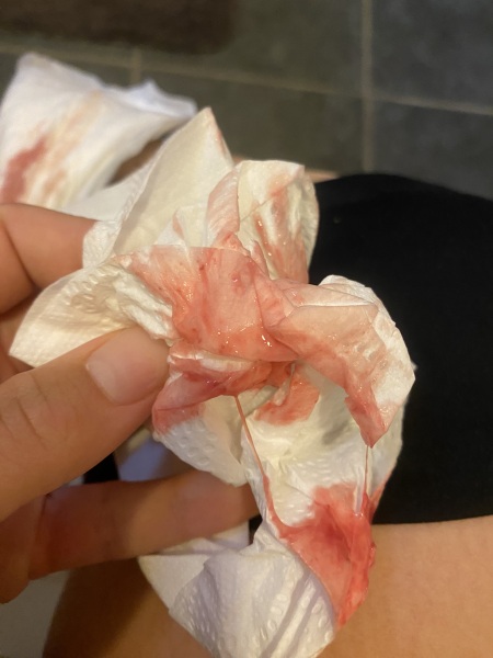 Week 16-18 Bleeding / Threat Miscarriage