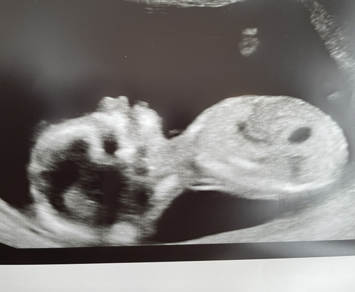 Skull theory  boy or girl ?
