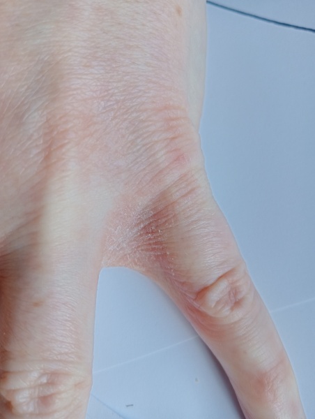 Could this be scabies??
