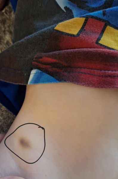 Bruises from nursery