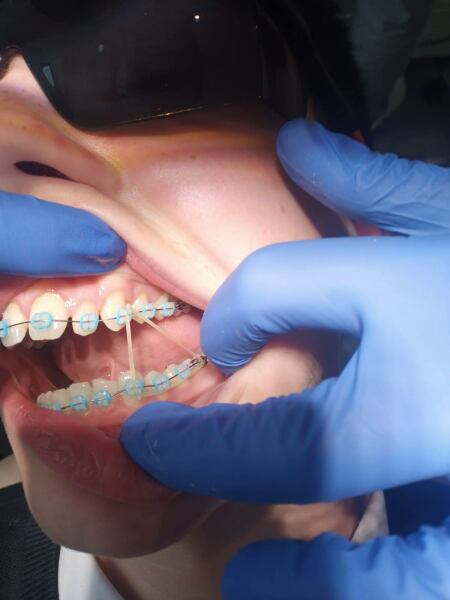 Teeth braces drama