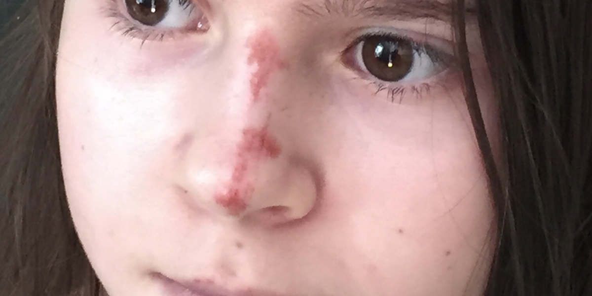 Will this graze scar?