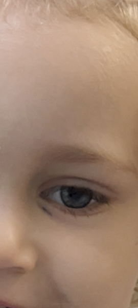 Pen ink deep under skin