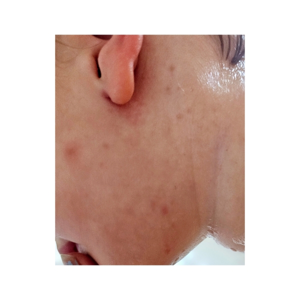To be concerned this isn't eczema?? Help!