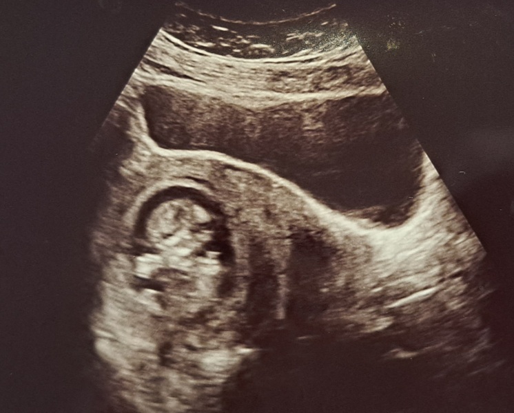 12 week scan-any ideas if it is a boy/girl?