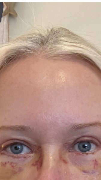 Does anyone want to come on my Upper and Lower Bleph and Necklift journey with me?