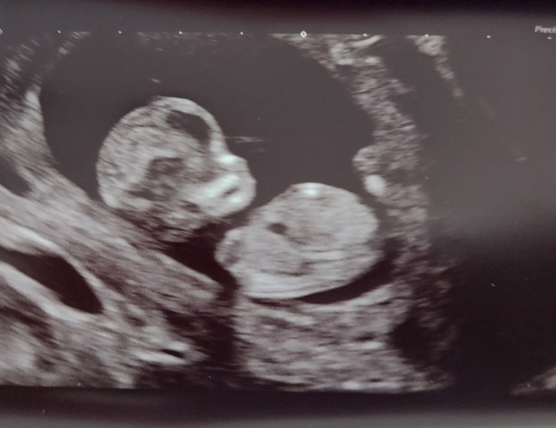 Nub/gender theory guesses - 12 weeks!