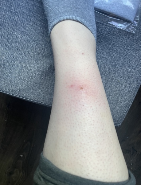 Cellulitis?