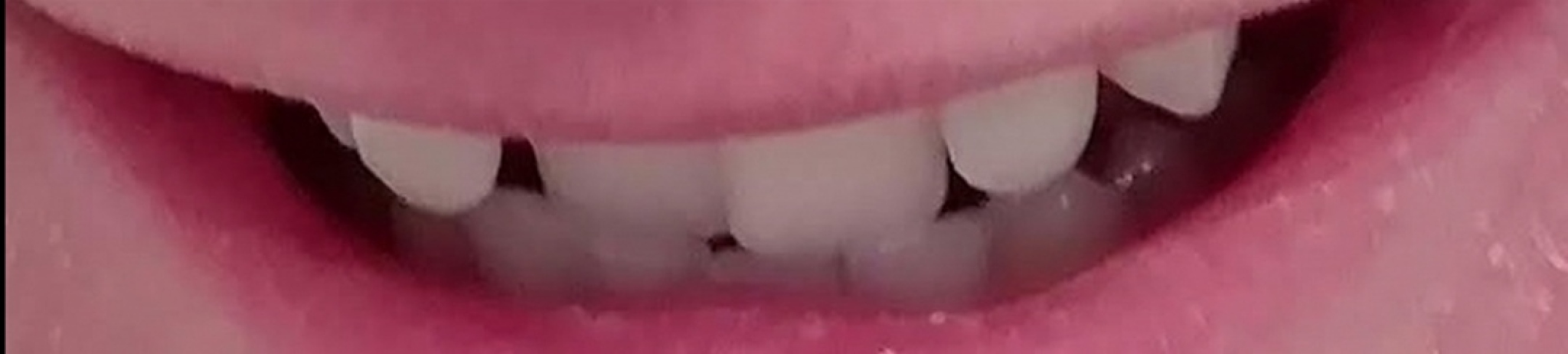 Teeth braces drama