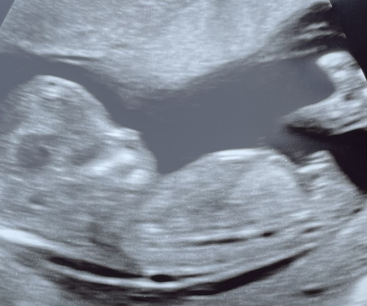 Nub theory guesses - a boy?