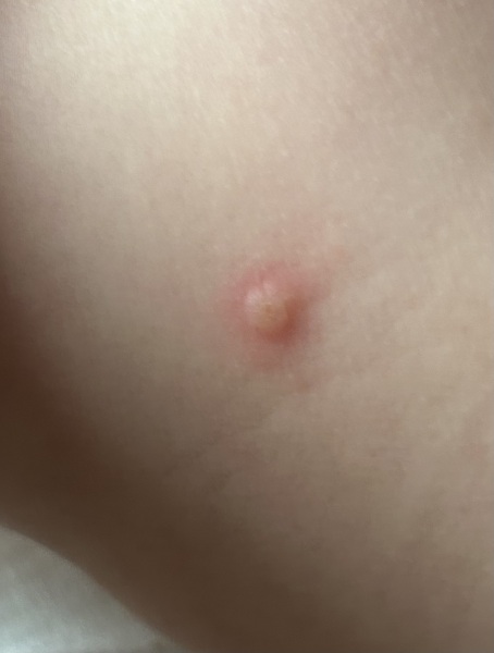 Chickenpox or HFM