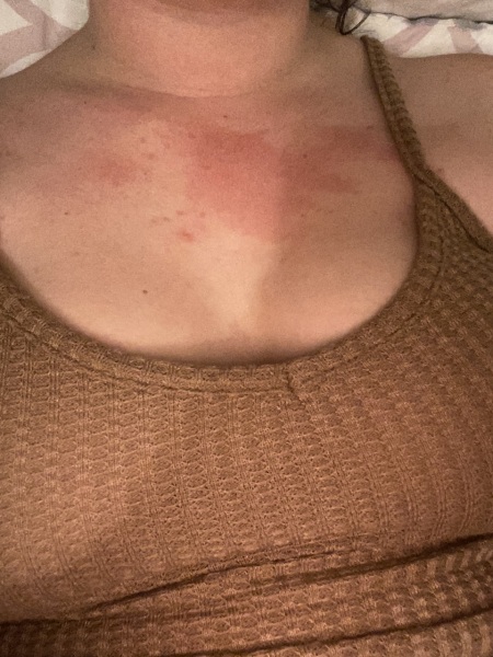 Rash?