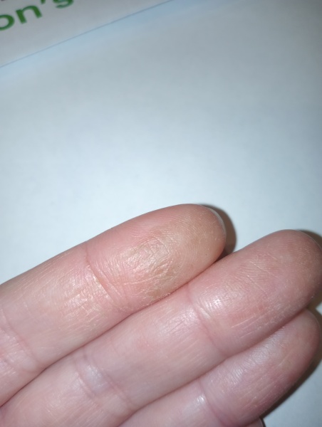 A wierd one- chopping basil and finger has turned numb, browny and peeling?!