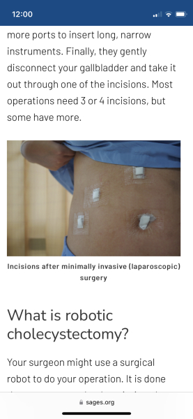 Gallbladder Removal