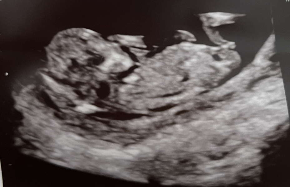 12 week scan - gender guess? I think it’s obvious…