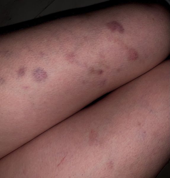 Bruising without reason