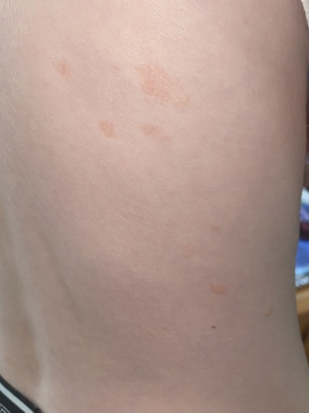 Rash on 7yr old son